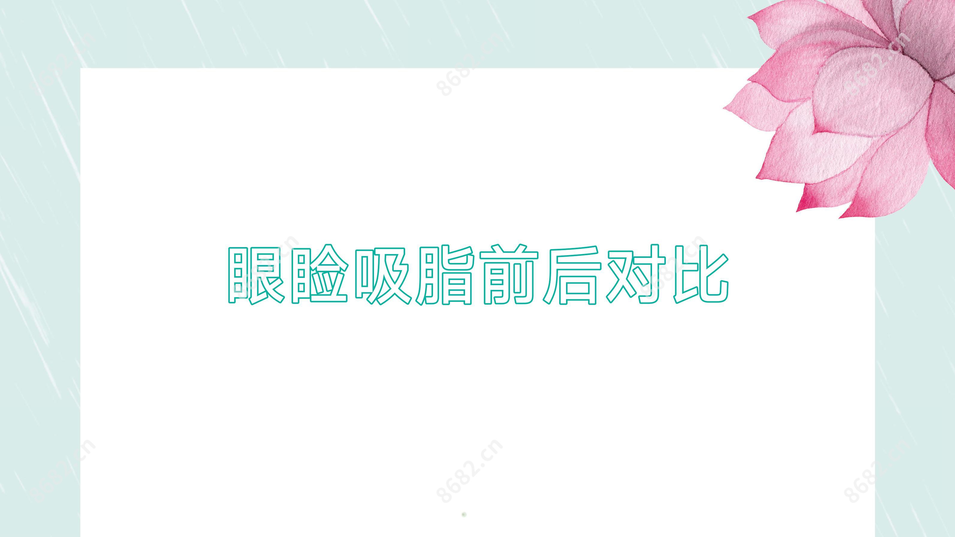 眼睑吸脂前后对比