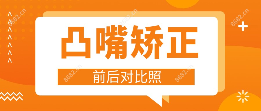 凸嘴矫正前后对比照