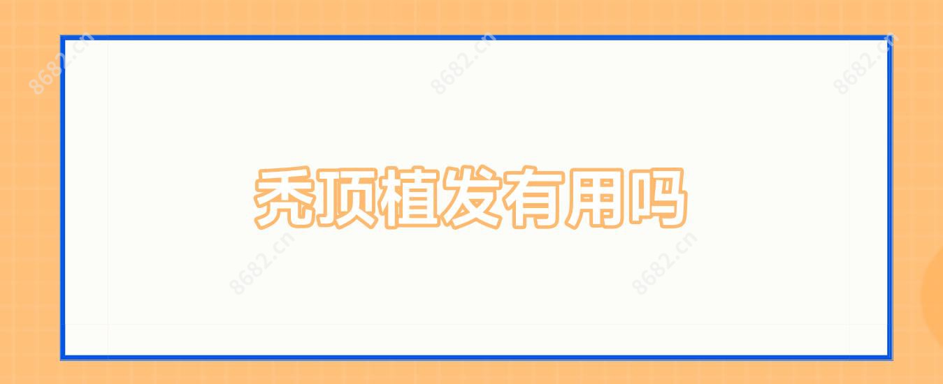 秃顶植发有用吗