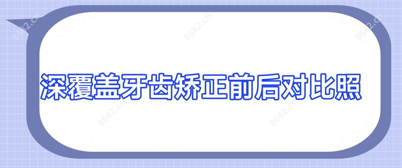 深覆盖牙齿矫正前后对比照