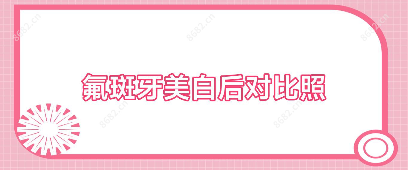 氟斑牙美白后对比照