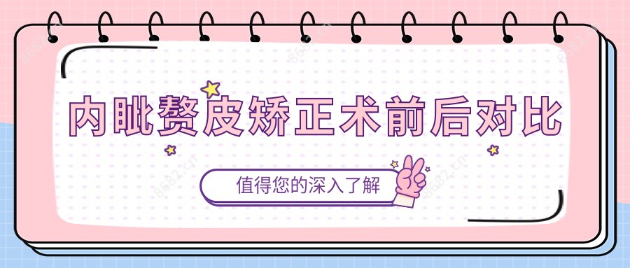 内眦赘皮矫正术前后对比