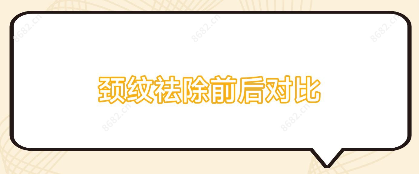 颈纹祛除前后对比