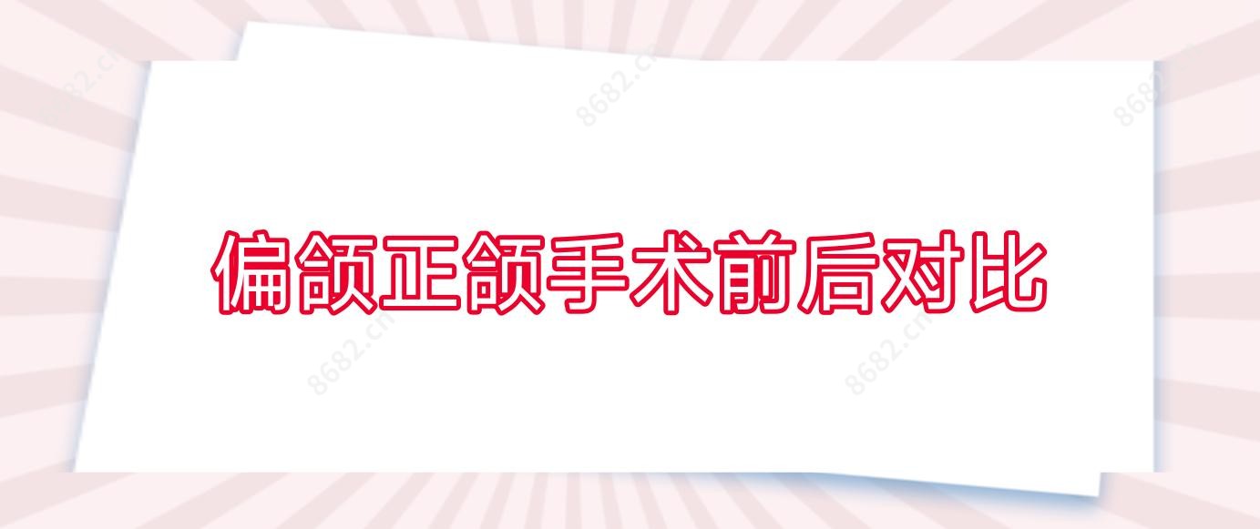 偏颌正颌手术前后对比