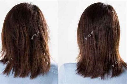 电波拉皮可用于什么部位的除皱?
