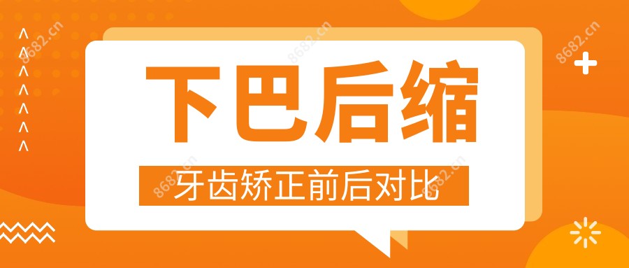 下巴后缩牙齿矫正前后对比